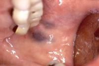 Oral malignant melanoma