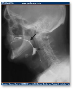 dysphagia-figure1