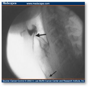 dysphagia-figure2