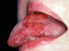 squamous cell carcinoma tongue