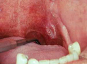Pictures Of Cancer In The Mouth