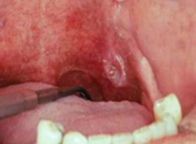 mouth cancer from alcohol