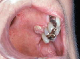 Cancerul oral – simptome, tratament