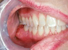 Oral Cancer Images - The Oral Cancer Foundation