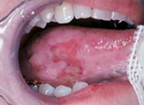 squamous cell carcinoma base of tongue