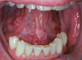 erythroplakia floor of mouth