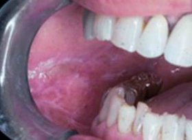 Oral Cancer Images - The Oral Cancer Foundation