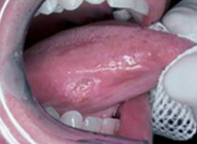 early squamous cell carcinoma mouth