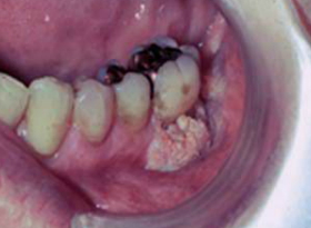 Diagnosis: Papillary squamous cell carcinoma