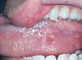 Oral Cancer Images - The Oral Cancer Foundation