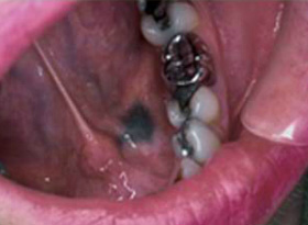 Diagnosis: Amalgam tattoo