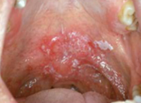 throat cancer from tobacco