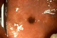 Oral malignant melanoma.