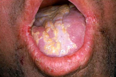 Candida Infection - Oral Cancer Foundation  Information and Resources  about Oral Head and Neck Cancer