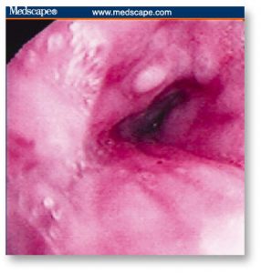 COPING WITH CHEMOTHERAPY: Stomatitis and Esophagitis